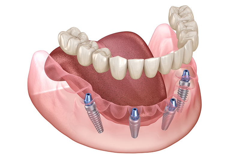 All on four Dental Implants in Poway