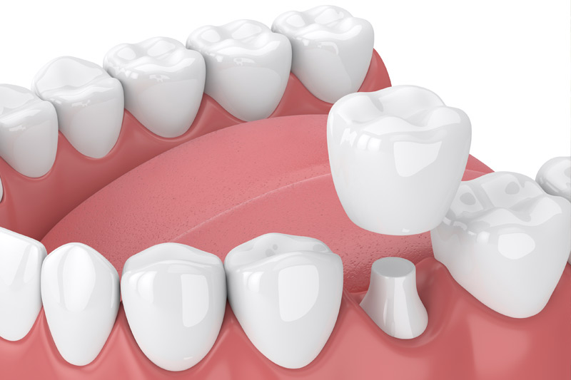 Dental Crowns in Poway