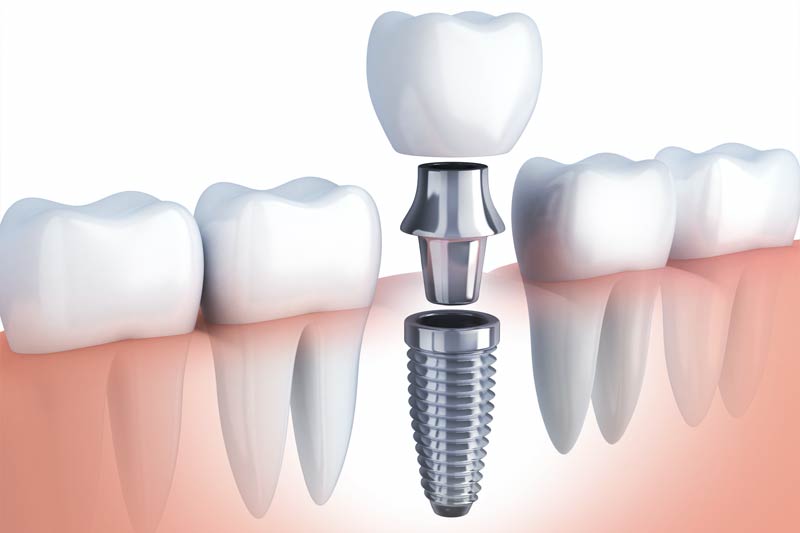 Dental Implants in Poway