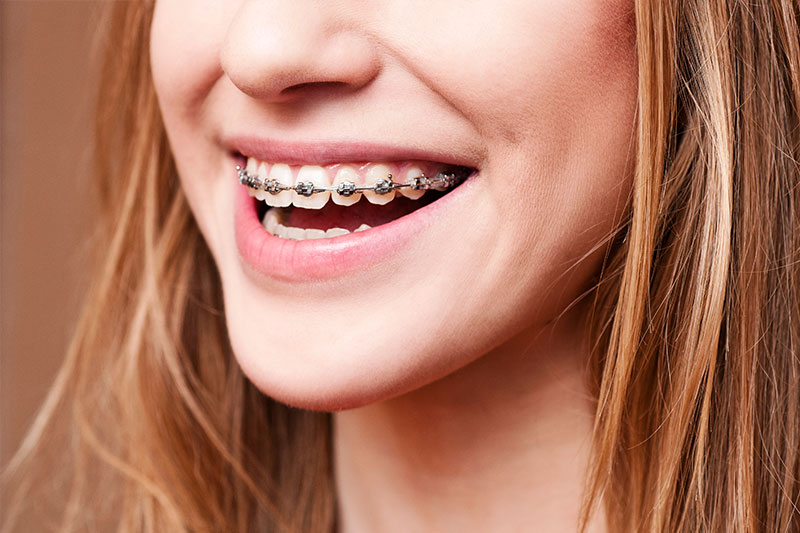 Orthodontics in Poway