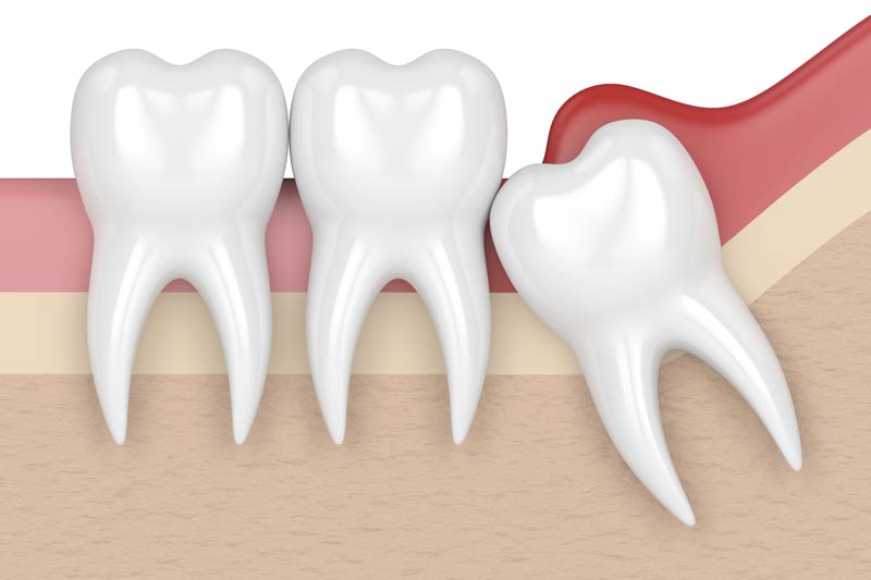 Wisdom Tooth Removal in Poway